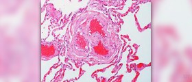 Prevention of deep vein thrombosis