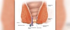 Prevention of hemorrhoids