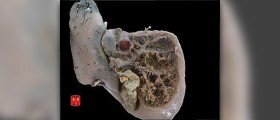 Prevention of hep c