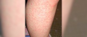 Prevention of hives