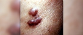 Prevention of kaposi's sarcoma