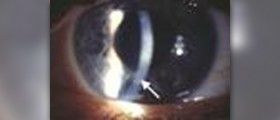 Prevention of keratitis