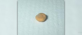 Prevention of kidney stones