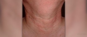 Prevention of laryngitis