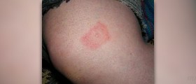 Prevention of lyme disease