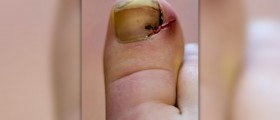 Prevention of nail fungus
