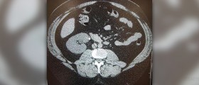 Prevention of nephrolithiasis