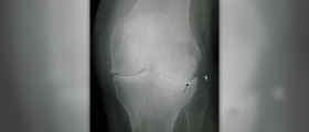 Prevention of osteoarthritis
