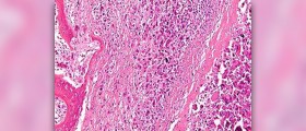 Prevention of osteoporosis in women