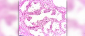 Prevention of pancreatic cancer