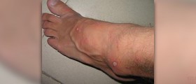 Prevention of sandfly bites