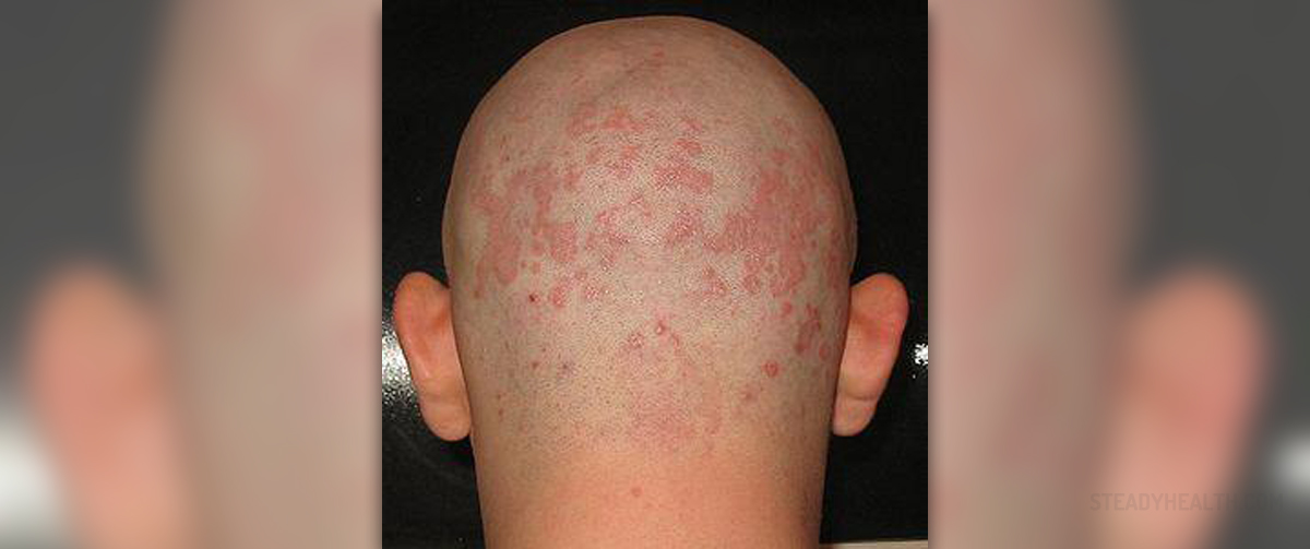 Prevention Of Seborrheic Dermatitis Skin And Hair Problems Articles