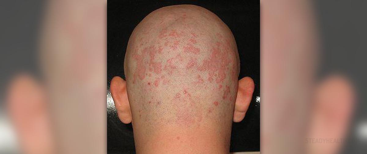 prevention-of-seborrheic-dermatitis-skin-hair-problems-articles