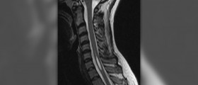 Prevention of syringomyelia