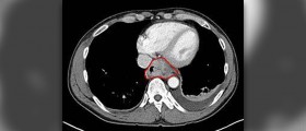 Prevention of tumor lysis syndrome