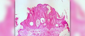 Prevention of vulvar cancer
