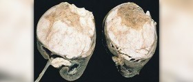 Prevention of wilms tumor