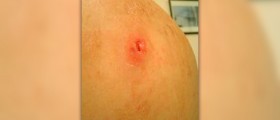 Prevention of wound infection