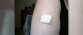 Price for mole removal