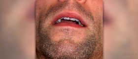 Problems of mouth breathing