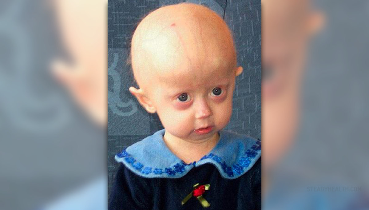 Progeria Definition Types Symptoms Facts Britannica