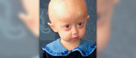 Progeria symptoms and treatment