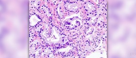 Prostate cancer natural cure