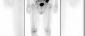 Prostate cancer radiation side effects