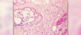 Chronic prostatitis symptoms
