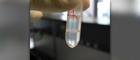 Protein in urine symptoms