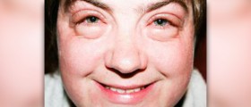 Puffy face causes and treatment