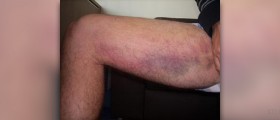 Pulled muscle symptoms