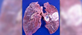 Pulmonary fibrosis natural cure