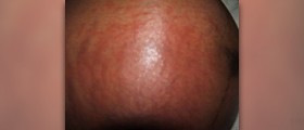 What are the symptoms of PUPPP?