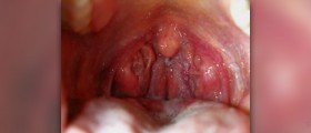 Pus on tonsils