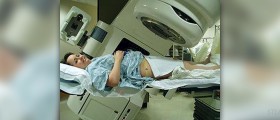 Radiation for lung cancer