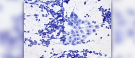 Radiation therapy for lung cancer