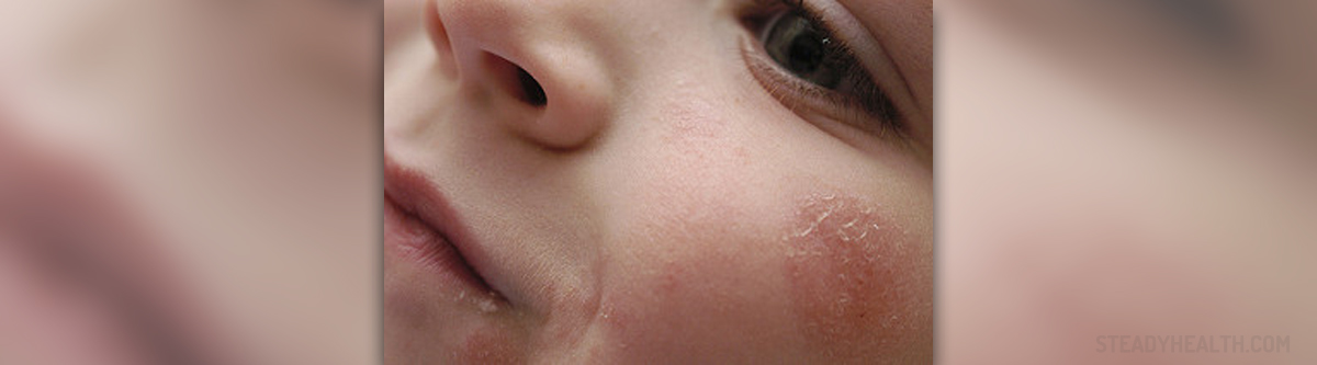 Eczema Around Eyes Skin Hair Problems Articles Body Health Conditions Center Steadyhealth Com