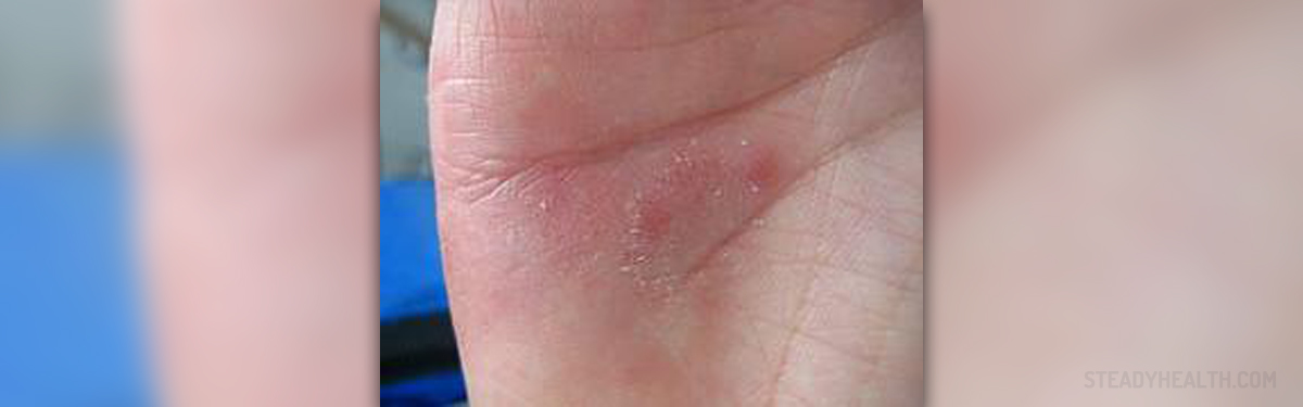 rash-on-hands-and-feet-skin-hair-problems-articles-body-health