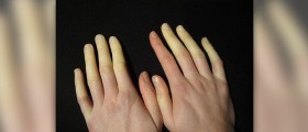 Raynaud's disease on foot