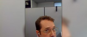 Receding hairline treatment