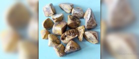 Recognizing the signs of gallstones