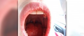 Recovery time after wisdom teeth removal