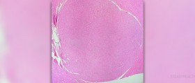Recovery time for hysterectomy