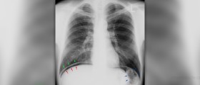 Recurrent pneumonia in children