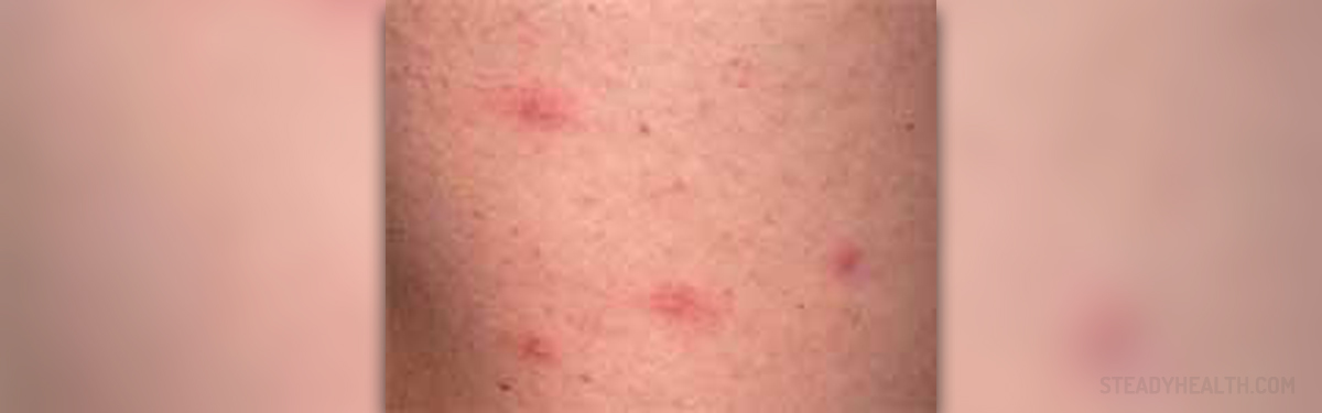 Red Bumpy Rash Cardiovascular Disorders And Diseases Articles Body Health Conditions Center Steadyhealth Com