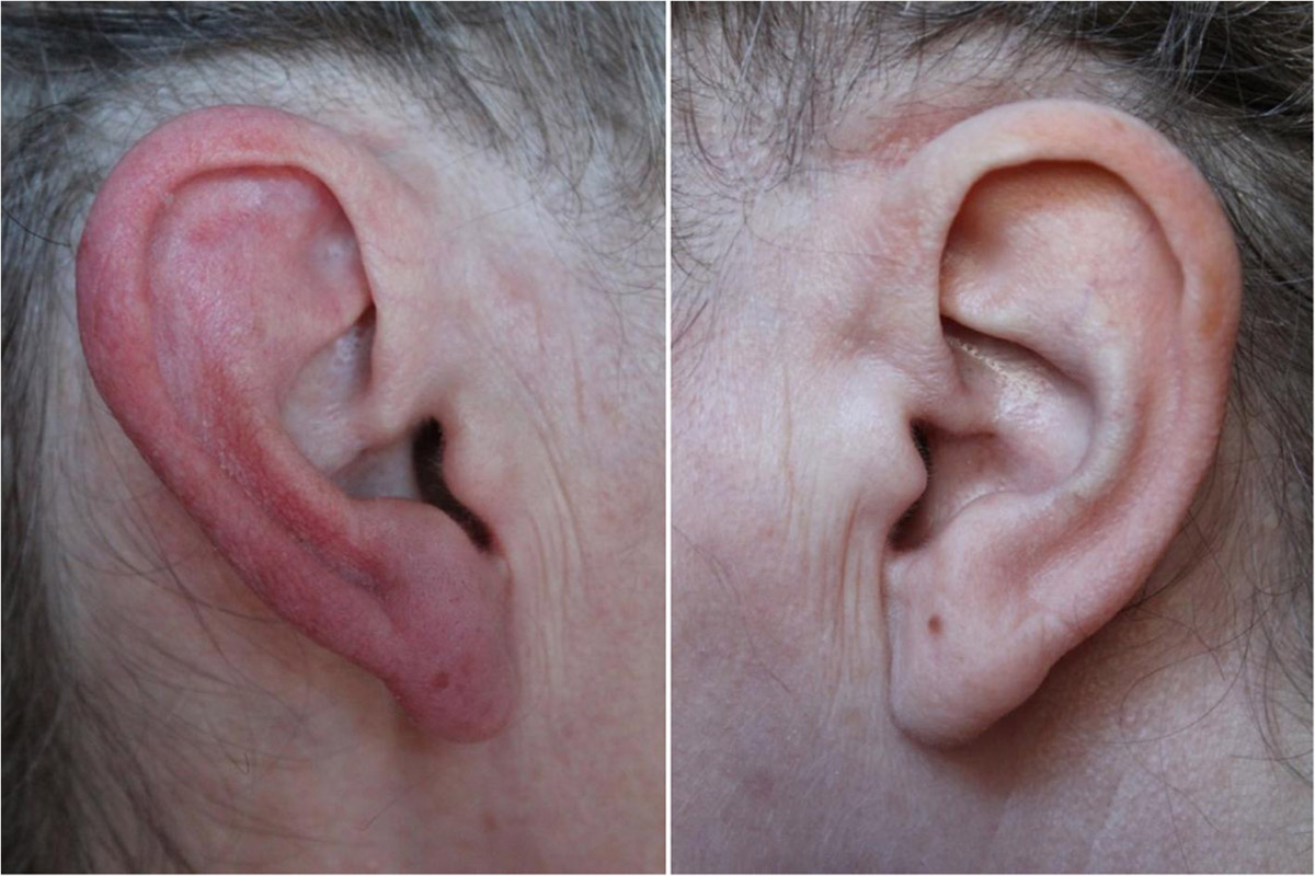 Red Ear Syndrome