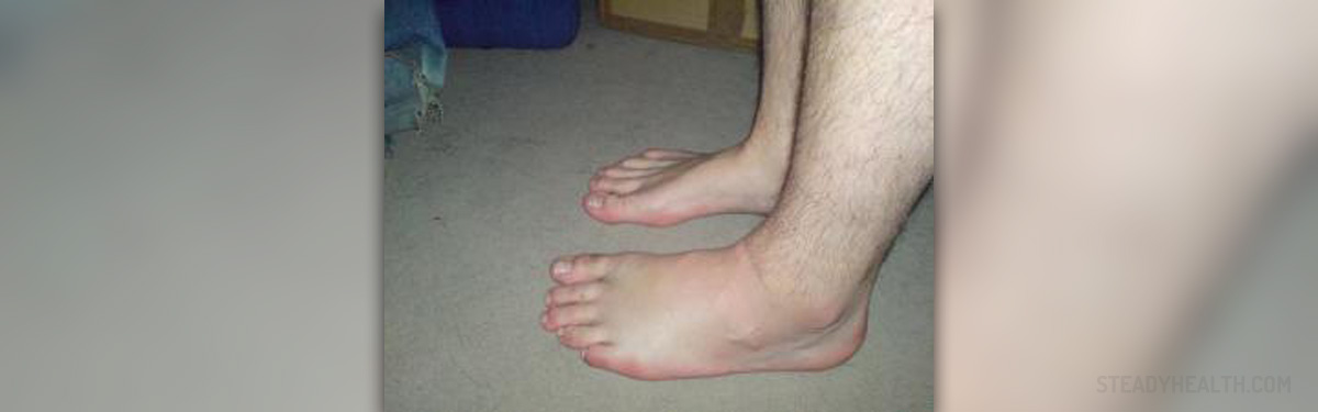 Red swollen feet | General center | SteadyHealth.com