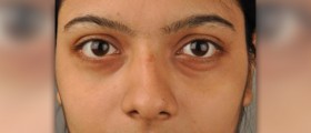 Reduce puffy eyes