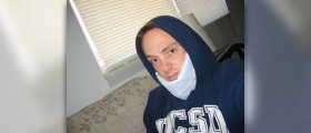Reduce swelling after wisdom teeth removal
